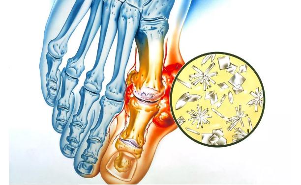 痛风如何能及早发现-冷眸生活