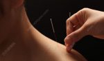 针灸减肥的基本原理是什么-冷眸生活
