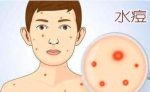 水痘如何治疗-冷眸生活