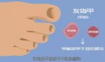 灰指甲怎么形成的(发生灰指甲前期症状是什么)-冷眸生活
