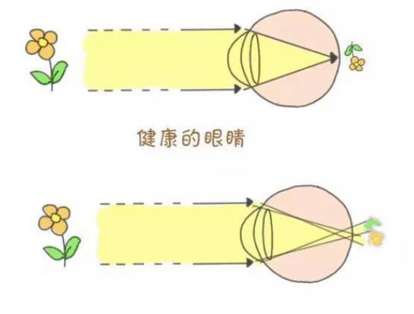 眼睛散光是什么回事-冷眸生活