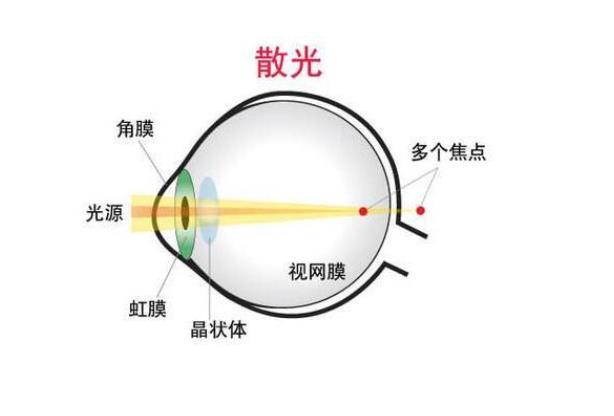 散光可以矫正过来吗(散光可以治好吗)-冷眸生活